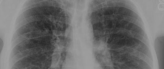 xray of chest and lungs